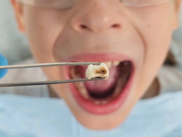 Best Dentist for Tooth Abscess  in Gray, LA